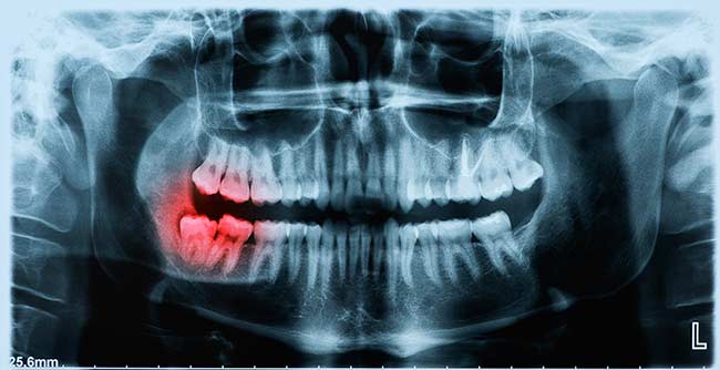 Wisdom Teeth Removal - Oral Surgery