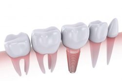 Dental Implants - Oral Surgery - Los Angeles