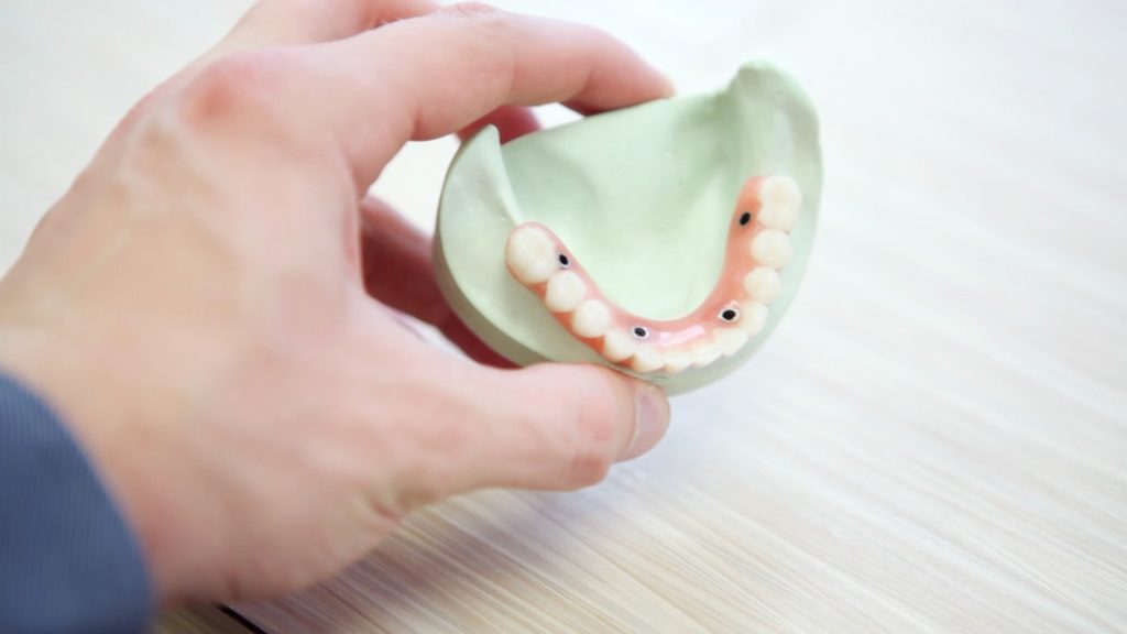 All-on-four teeth