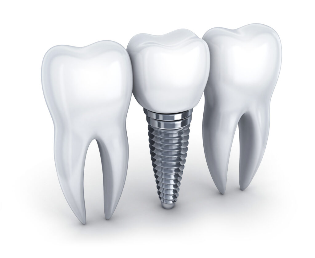 dental implant pricing