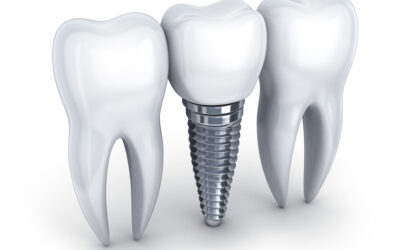 dental implant pricing